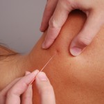 Acupuncture